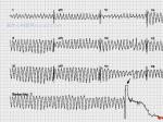 Polymorphic Ventricular Tachycardia