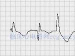 ŤתĶTorsade de pointes ventricular tachycardia