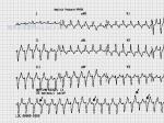 ٰȷķҷVentricular tachycardia with clear AV dissociation