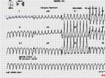 ٰ鲻ȷķҷVentricular tachycardia with subtle AV dissociation