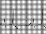 Ventricular premature beats