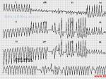 ķ˲W-P-W wolff-Parkinson-White syndrome with atrial fibrillation