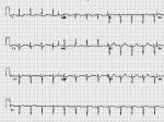 ĶSinus tachycardia