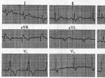 ֧Right Bundle Branch Block