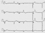 ȫԷҴͰķ˲Atrial fibrillation and complete heart block