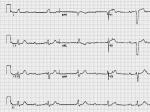 ȫԷҴComplete Heart Block