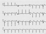 һȷҴ first degree heart block