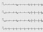 ¾±ļOld inferior myocardial infarctiona