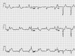 ļ֧Acute myocardial infarction in the presence o