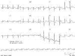 Ժļ  Acute posterior myocardial infarction