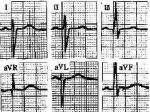 ҷʺ Right Ventricular Hypertrophy