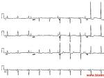 ҷʺ left atrial hypertrophy