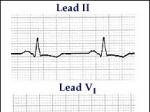  left atrial enlargement