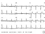 ĵͼ normal ecg