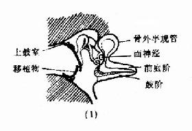 图9-6 鼓室成形术