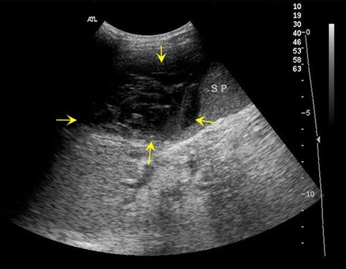 脾破裂(超声图)