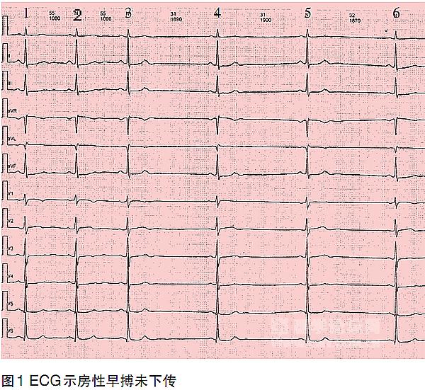 教你读懂心电图