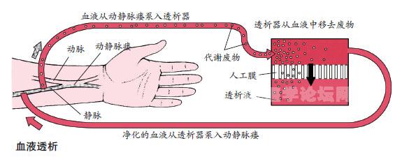 透析有两种方式,血液透析和腹膜透析.