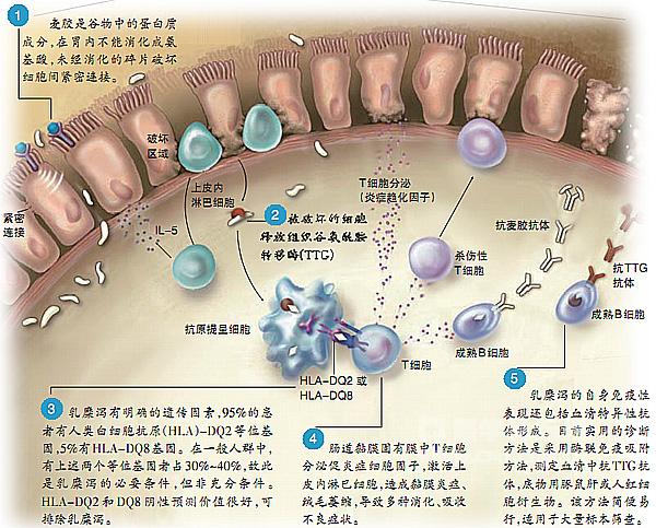 什么叫做乳糜泻麦胶性肠病的诊断和治疗