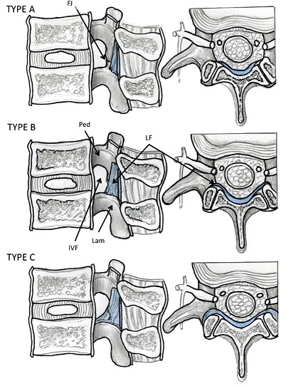 腰椎黄韧带与椎板椎间孔关系解剖研究