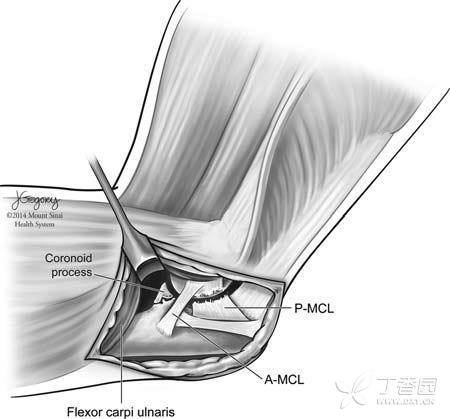 手术技术:尺骨冠突骨折的新型手术入路